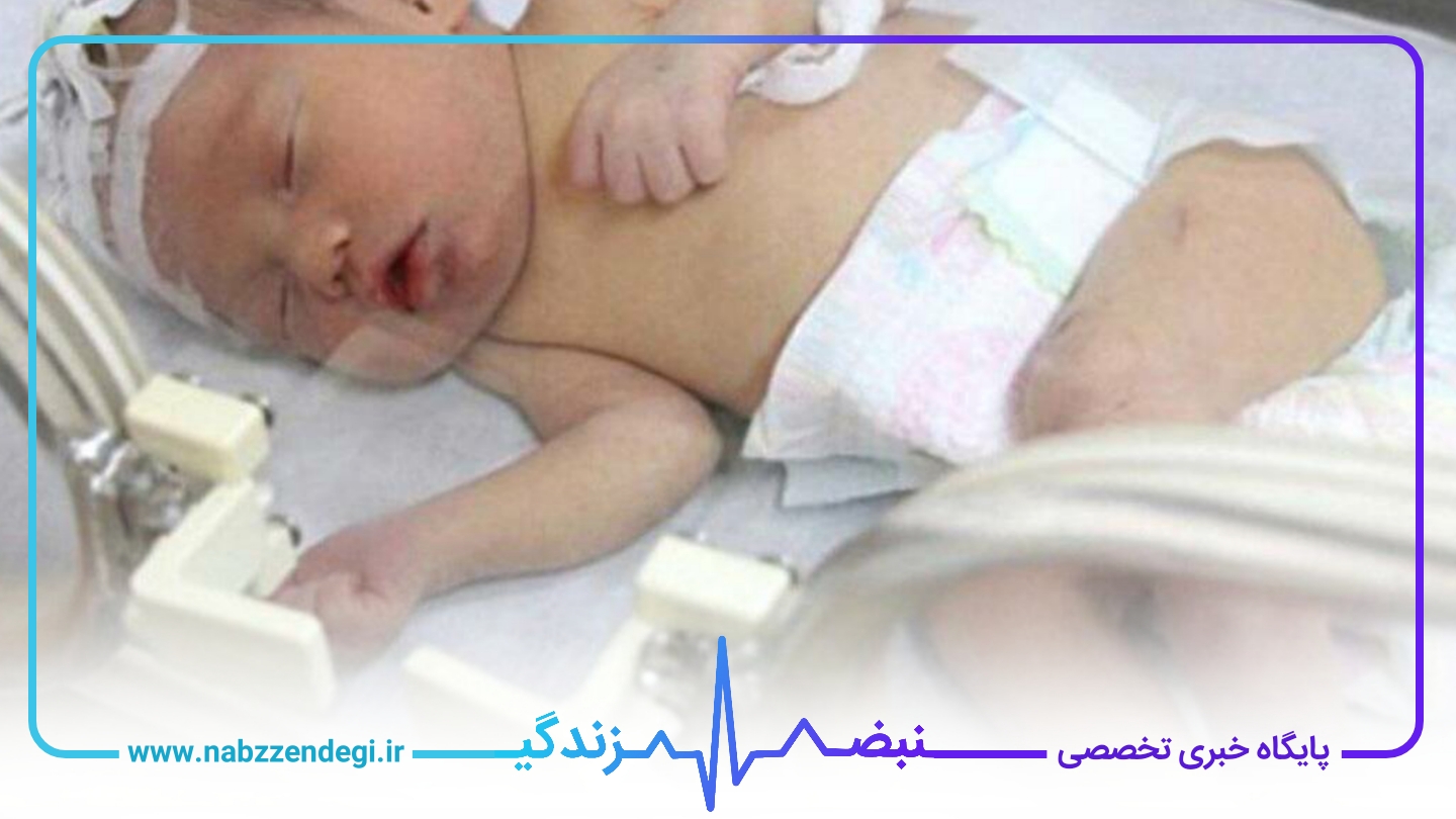 فلج شدن نوزاد بر اثر شکستن قلنج